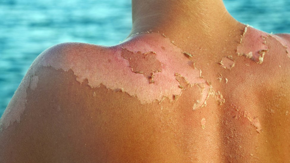 Bronceado extremo: la nueva obsesión entre adolescentes que puede costarles la piel