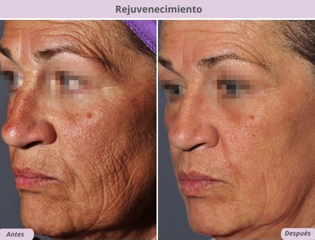 Adiós filtros: así se logra el verdadero glow sin exagerar con rellenos